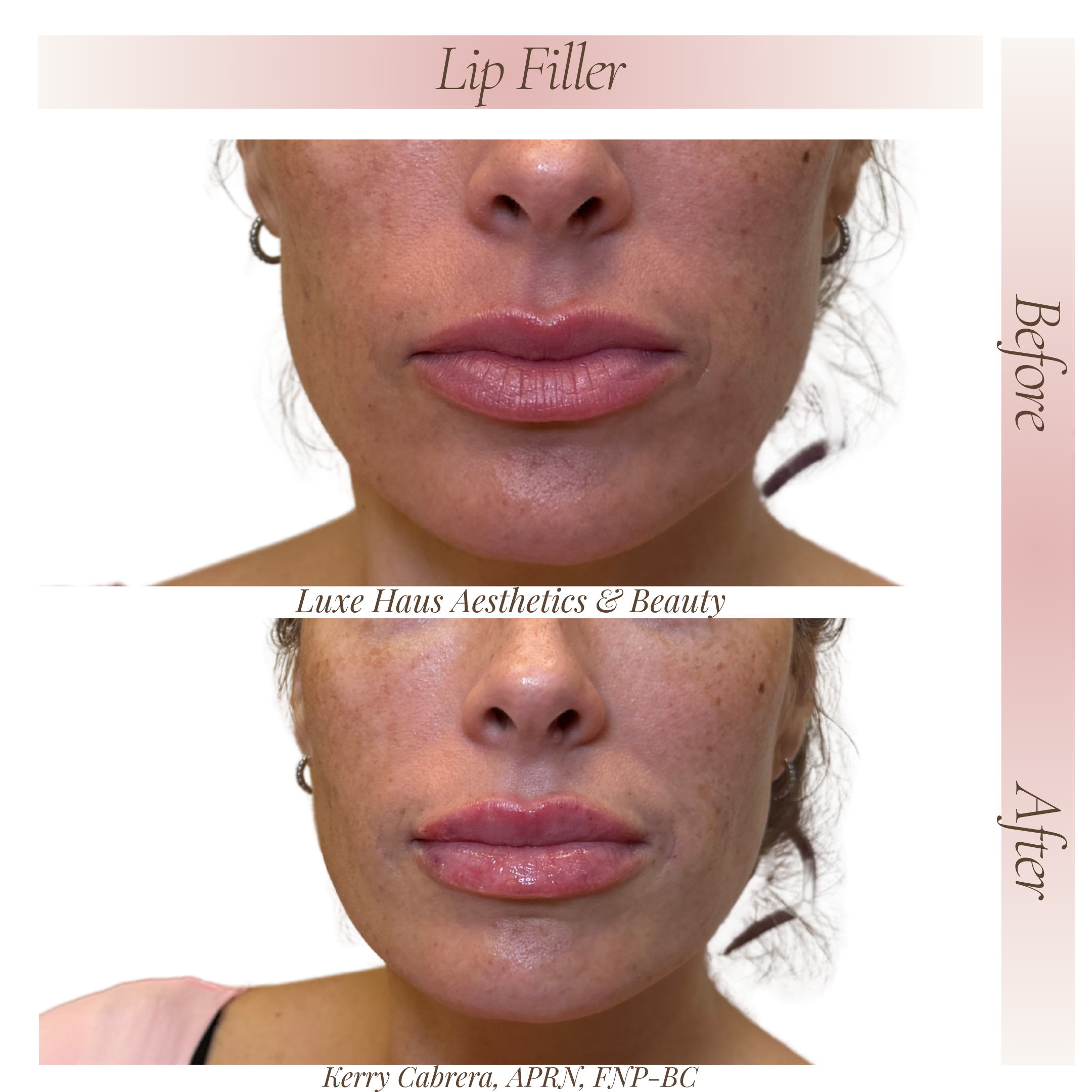 Before Lip Filler 4